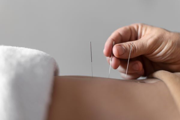 infissione di punti di agopuntura a livello del dorso